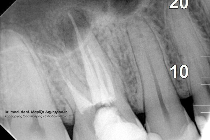 Ενδοδοντιστής Θέρμη Κοντοπουλος μετα