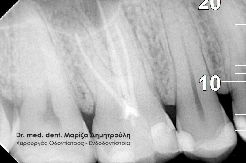 Ενδοδοντολόγος Θεσσαλονίκη Κοντοπουλος πριν