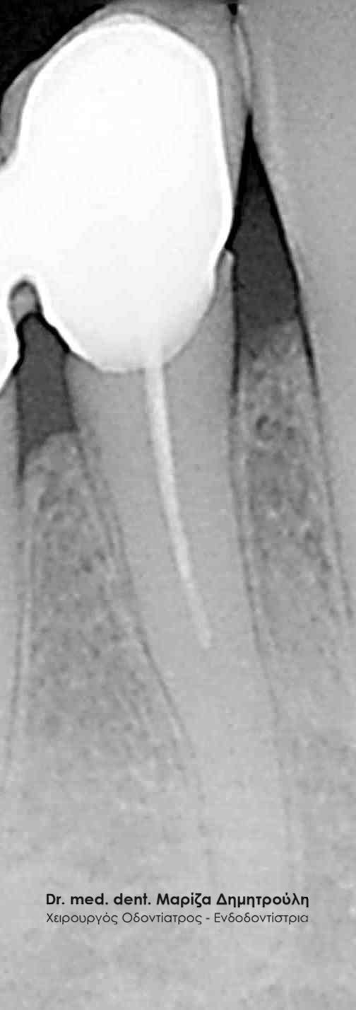 Επανάληψη απονεύρωσης Πριν Χισεκορ