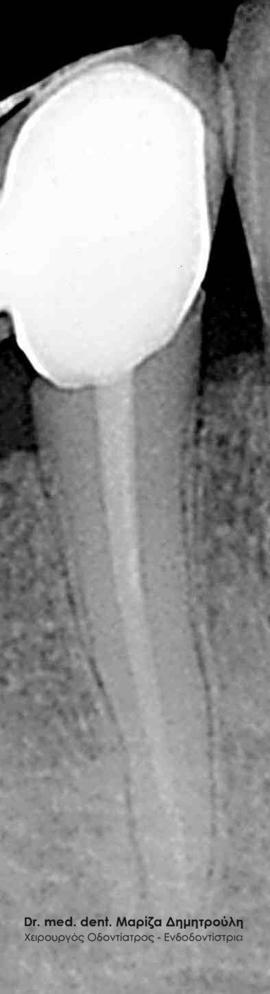 Οδοντίατρος Θέρμη Χισεκορν μετα