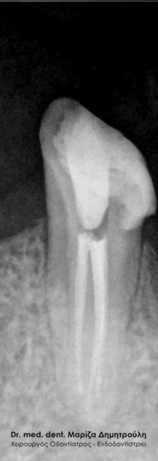 απονεύρωση δοντιού Απονεύρωση δοντιού