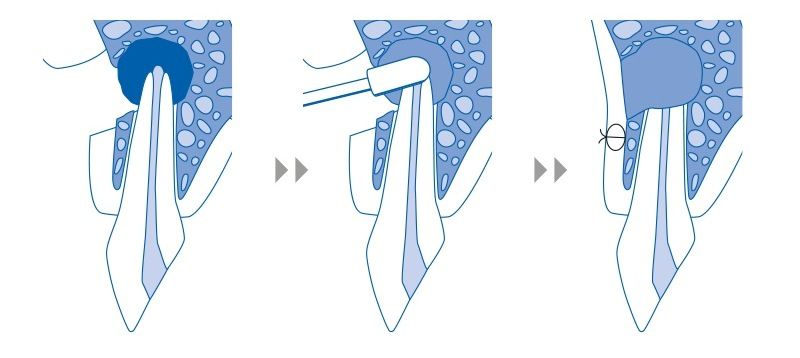 Ακρορριζεκτομή Δοντιού