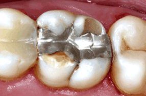 Ενδοδοντολόγος Θέρμη Insufficient filling