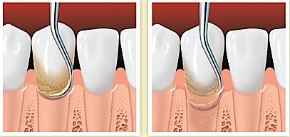 Θεραπεία περιοδοντίτιδας
