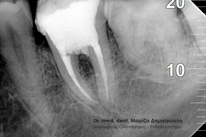 απονευρωση δοντιου TELIKH