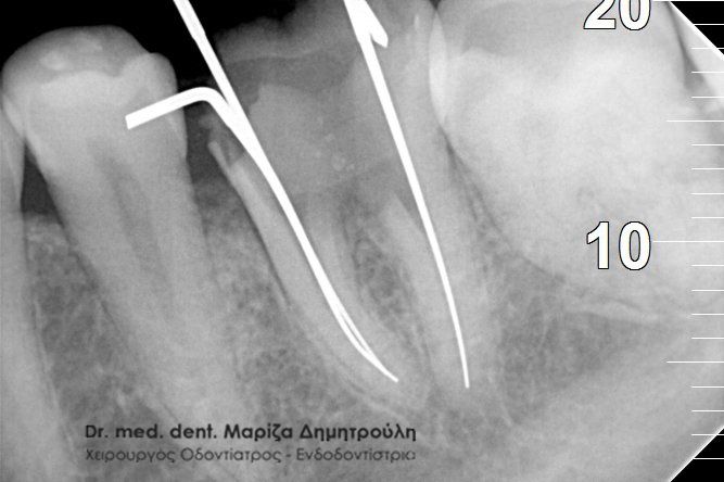 Επανάληψη απονεύρωσης TRITOS SOLINAS