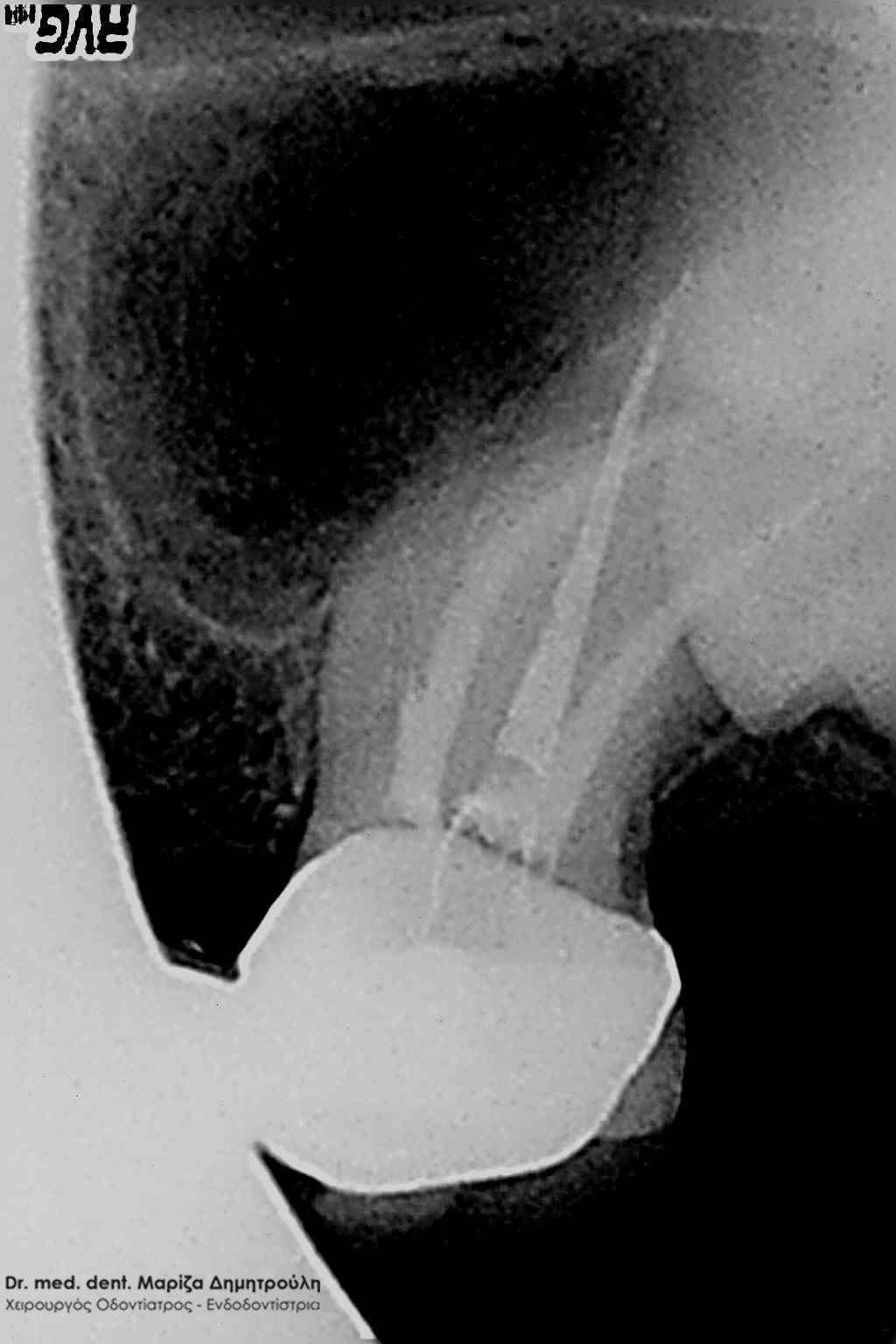 Ενδοδοντιστής Θερμη Wf