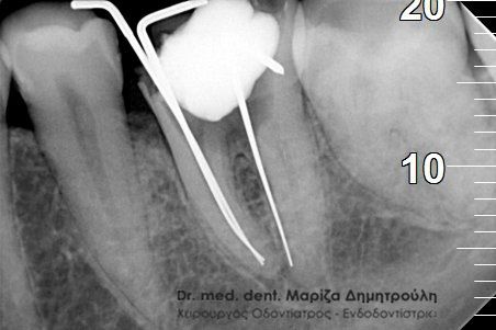 Απονευρωση δοντιου diatrhsh