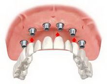 maseles epiemfyteumatikh