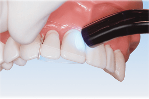 matrix band front tooth