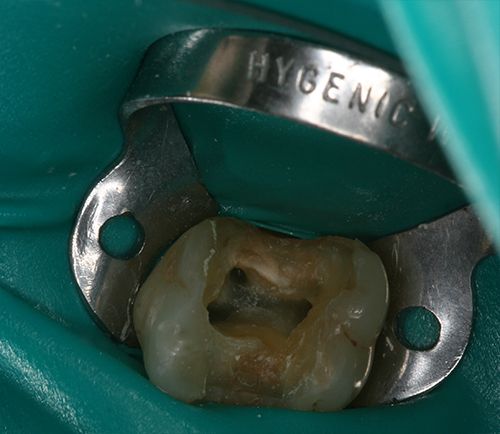 Ενδοδοντολόγος Θεσσαλονίκη Ενδοδοντολόγος Θεσσαλονίκη