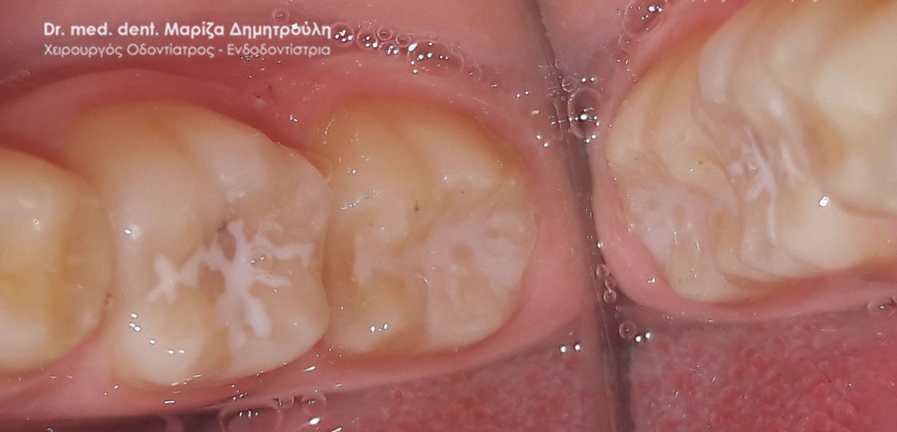 παιδοδοντιατροι θεσσαλονικη sealant 22