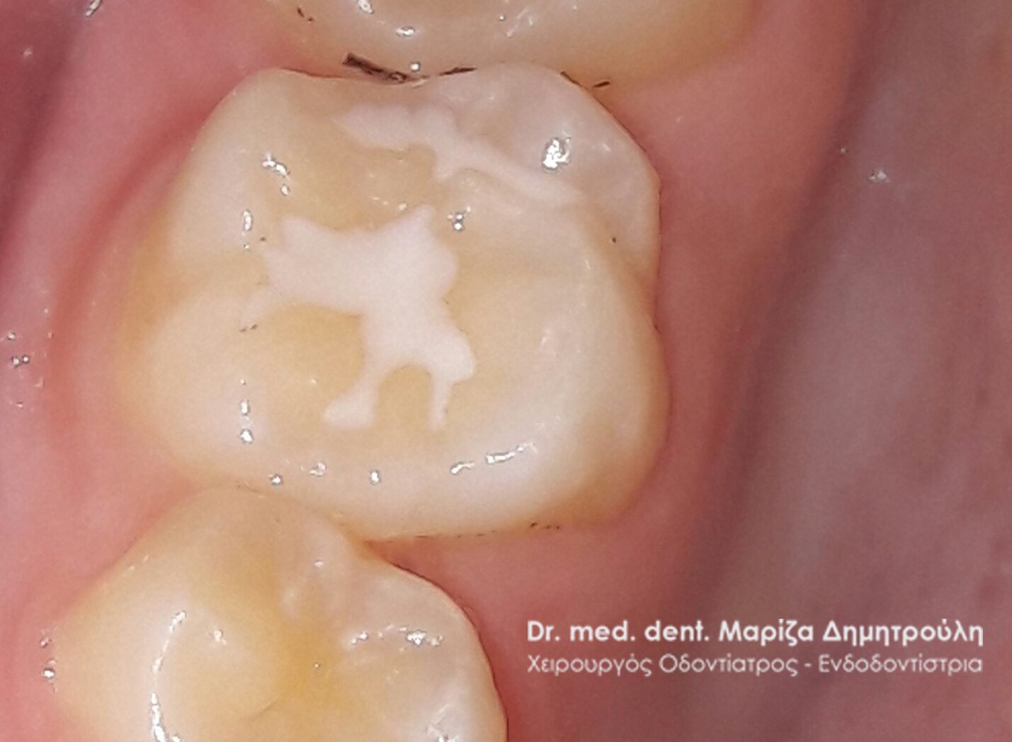 παιδοδοντιατροι θεσσαλονικη sealant 33