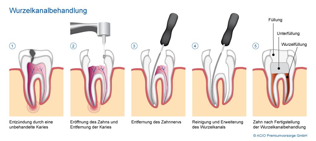 Απονεύρωση Δοντιού
