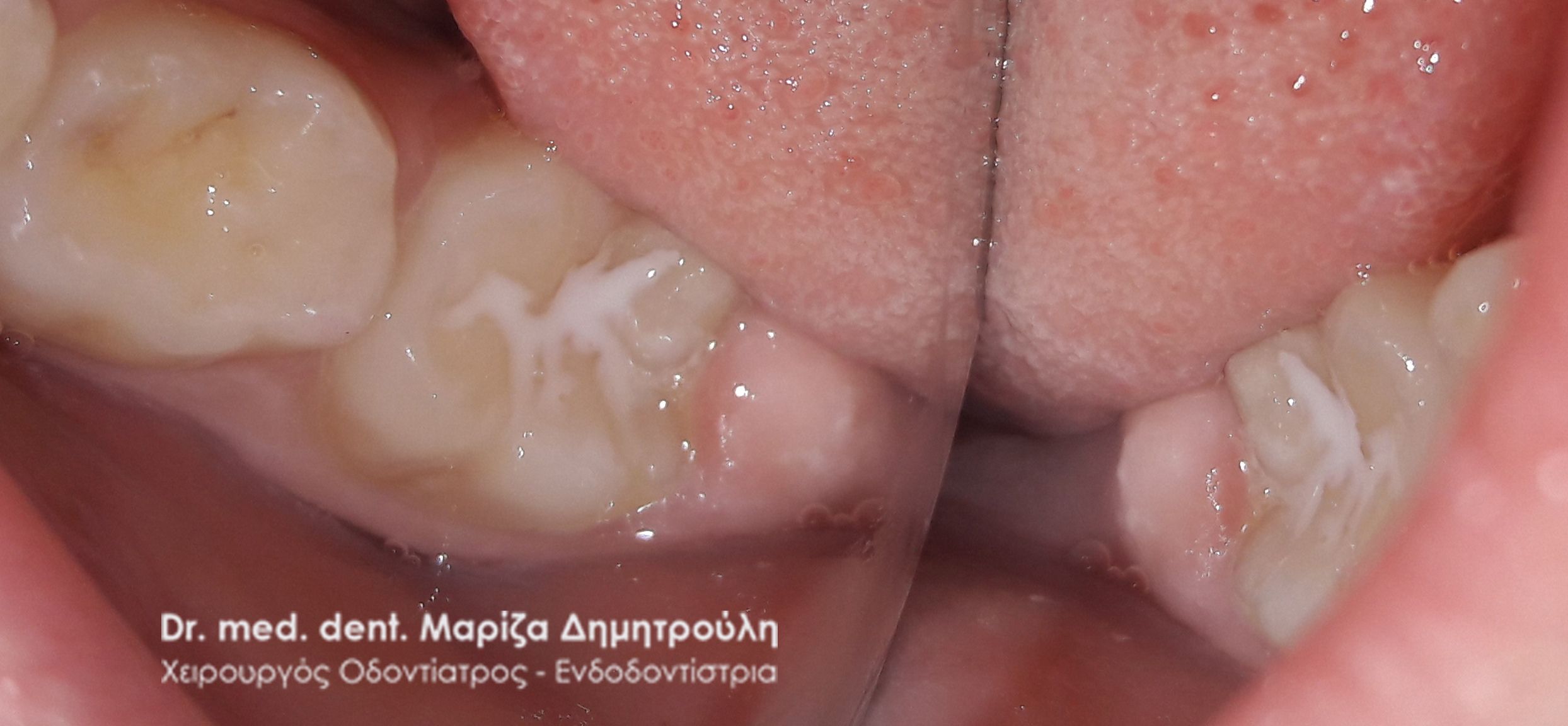 παιδοδοντιατροι θεσσαλονικη sealant 55